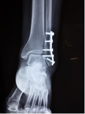 xray after Ankle Fusion